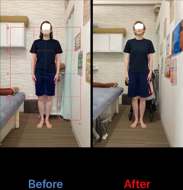 アクル整骨院 | 南町田在住/産後骨盤矯正／産後２か月／３３歳／女性／第二子出産／施術期間３か月半／ - IMG_1147