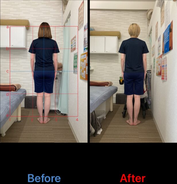 アクル整骨院 | 南町田在住/産後骨盤矯正／産後２か月／３３歳／女性／第二子出産／施術期間３か月半／ - IMG_1149 (1)