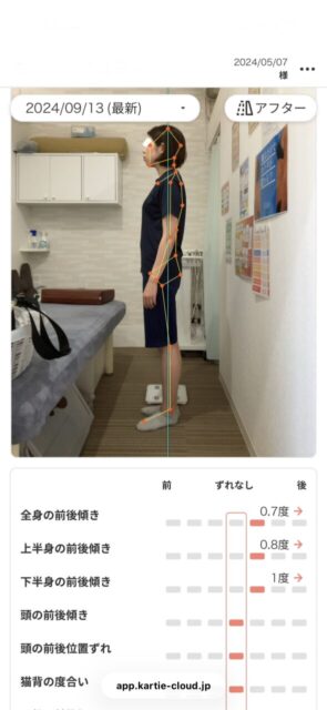 アクル整骨院 | 産後骨盤矯正／町田市金森在住/33歳女性／産後3か月／第1子出産／施術期間 約4か月 - 22d553a0d843429198f3b69f7d9a75c6-589×1280