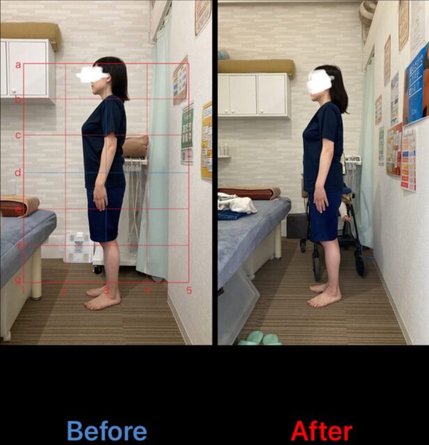 アクル整骨院 | 産後骨盤矯正／38歳女性／第二子出産／産後５か月／施術期間約４か月／町田市小川在住 - 3afd3eaaafcae945e94c9721f82c766d-1232×1280