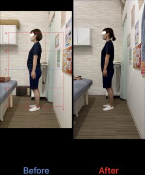 アクル整骨院 | 町田市南町田在住／産後骨盤矯正／産後1か月／第2子出産／33歳女性／施術期間 約3か月／ - 3dd1b9ba8684aa3ba21f40c3153979ea-299×360