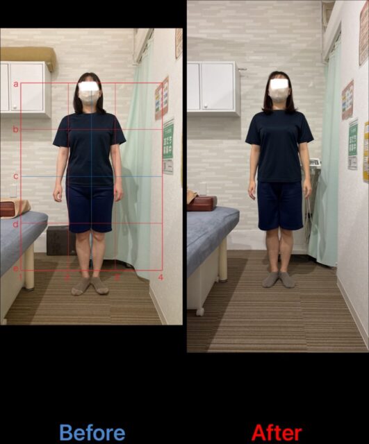 アクル整骨院 | 南町田在住/産後骨盤矯正／37歳女性/第1子出産/産後１か月/施術期間約４か月/ - 4bafd30daaff16d55ca3c716bfc73878-1062×1280