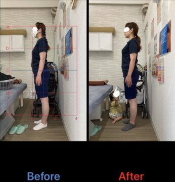 アクル整骨院 | 産後骨盤矯正／42歳女性／産後10か月／第3子出産／施術期間 約4か月／町田市小川在住 - 53f7dd55a45fd7daab22b44346c3f45f-346×360