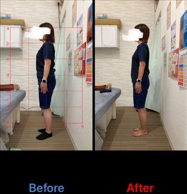 アクル整骨院 | 南町田在住/産後骨盤矯正／36歳女性／産後9か月／第二子出産／施術期間 約４か月／ - 5a550028a3e8c7b62dce1aee55f23360-1232×1280