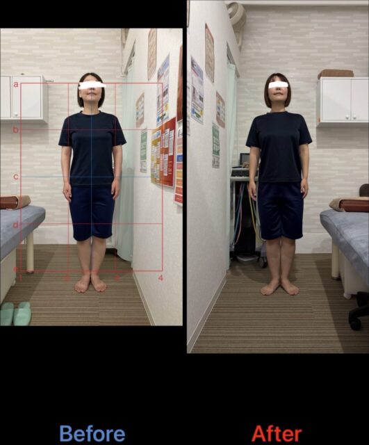 アクル整骨院 | 南町田在住/産後骨盤矯正／33歳女性／産後2か月／第一子出産／施術期間約3か月／ - 5d2a95495cb6140d4046a4d95d1faf2e-1062×1280