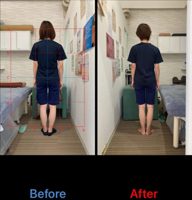 アクル整骨院 | 産後骨盤矯正／38歳女性／産後1か月／第3子出産／施術期間 約4か月／町田市小川在住 - 5e067fb4060f1a111affe02a5bc7784d-1232×1280