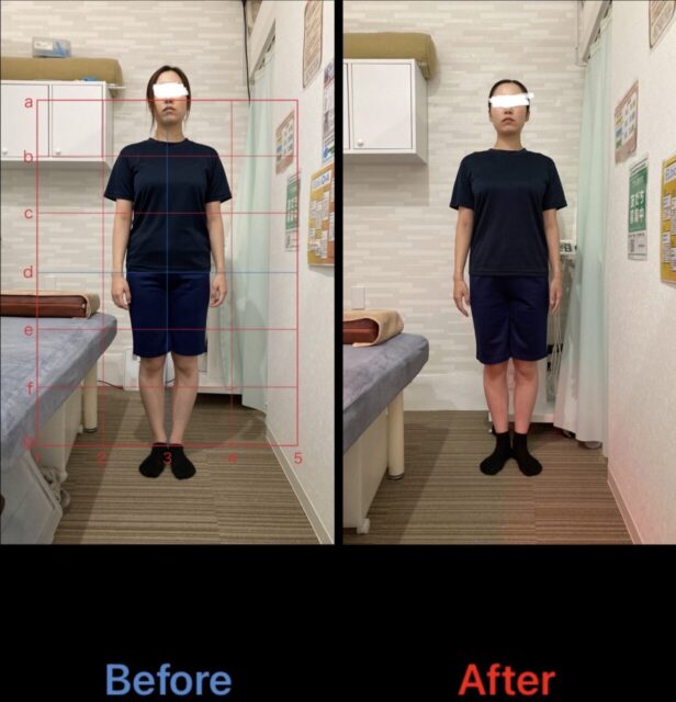 アクル整骨院 | 町田市鶴間在住/産後骨盤矯正/31歳女性/第二子出産/産後1か月/施術期間約4か月/ アクル整骨院 | 町田市鶴間在住/産後骨盤矯正/31歳女性/第二子出産/産後1か月/施術期間約4か月/ - 74b8f01c52831fedc44782c72674c120-1232×1280