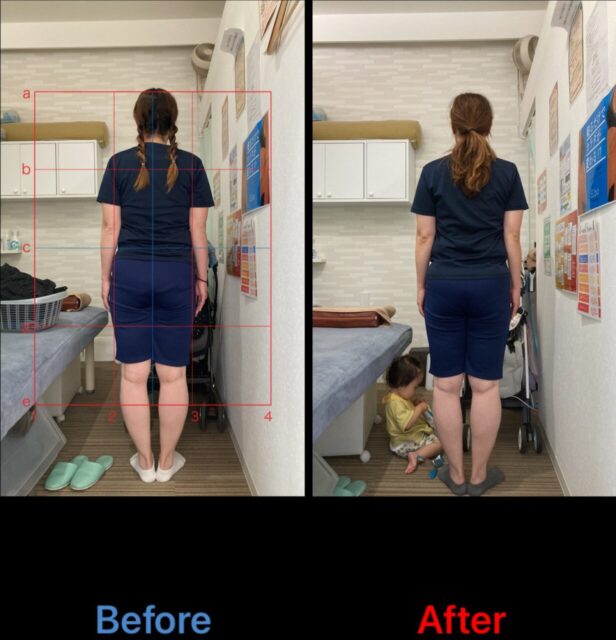 アクル整骨院 | 産後骨盤矯正／42歳女性／産後10か月／第3子出産／施術期間 約4か月／町田市小川在住 - 7eaa461fa02c4e263730ab171658275a-1232×1280