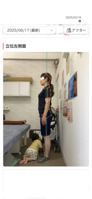 アクル整骨院 | 産後骨盤矯正／42歳女性／産後10か月／第3子出産／施術期間 約4か月／町田市小川在住 - 90906a7d35f31c10fff39477d2f688f0-589×1280