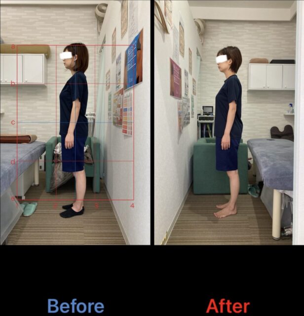 アクル整骨院 | 産後骨盤矯正／38歳女性／産後1か月／第3子出産／施術期間 約4か月／町田市小川在住 - 981fbac15a6ff121359c3430393f261e-1232×1280