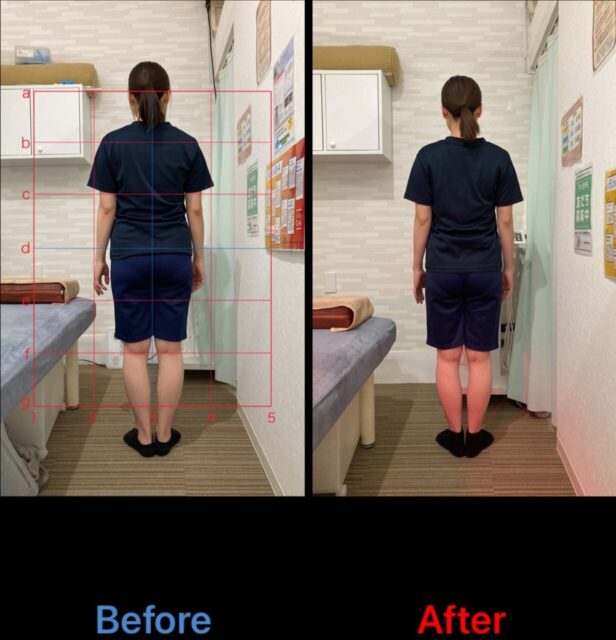 アクル整骨院 | 町田市鶴間在住/産後骨盤矯正/31歳女性/第二子出産/産後1か月/施術期間約4か月/ アクル整骨院 | 町田市鶴間在住/産後骨盤矯正/31歳女性/第二子出産/産後1か月/施術期間約4か月/ - a87005bb0634728b62f5edaad80272ba-1232×1280