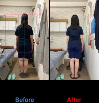 アクル整骨院 | 南町田在住/産後骨盤矯正／31歳女性／産後4か月／第一子出産／施術期間約4か月／ - d8464b6c5810f48cb5f8e2282e02fd4b-346×360