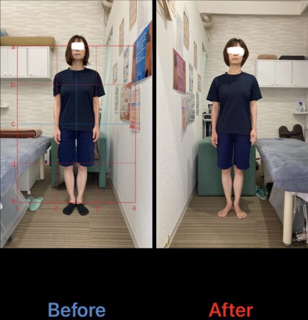 アクル整骨院 | 産後骨盤矯正／38歳女性／産後1か月／第3子出産／施術期間 約4か月／町田市小川在住 - fff8f320cc00a5f240170334024202f5-1232×1280
