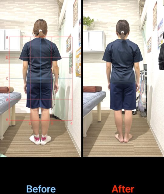 アクル整骨院 | 産後2か月/産後骨盤矯正/町田市金森在住/32歳女性/第1子出産/施術期間 約3か月 アクル整骨院 | 産後2か月/産後骨盤矯正/町田市金森在住/32歳女性/第1子出産/施術期間 約3か月 - 7fd00adae69116fd1e5509d7da327691-1297×1536