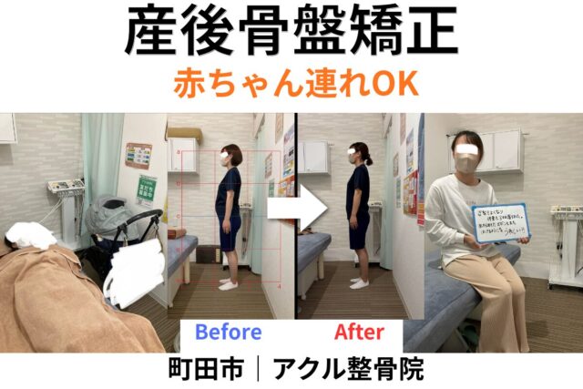 アクル整骨院 | 南町田・成瀬の産後骨盤矯正で 産後半年~1年後以降でも遅くない?産後骨盤矯正でできること 2026.3.10(火) アクル整骨院 | 南町田・成瀬の産後骨盤矯正で 産後半年~1年後以降でも遅くない?産後骨盤矯正でできること 2026.3.10(火) - machida-sango-kotsuban-kyosei-akuru-seikotsuin.jpg